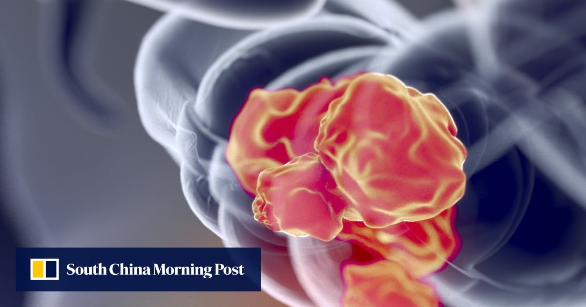 Nearly 300 colorectal cancer cases identified in Hong Kong screening