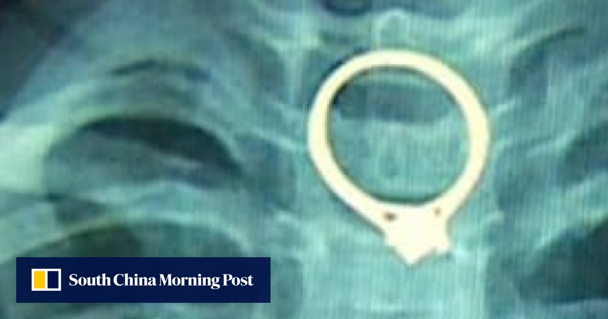 Two-year-old Chinese girl swallows mother's diamond ring | South ...