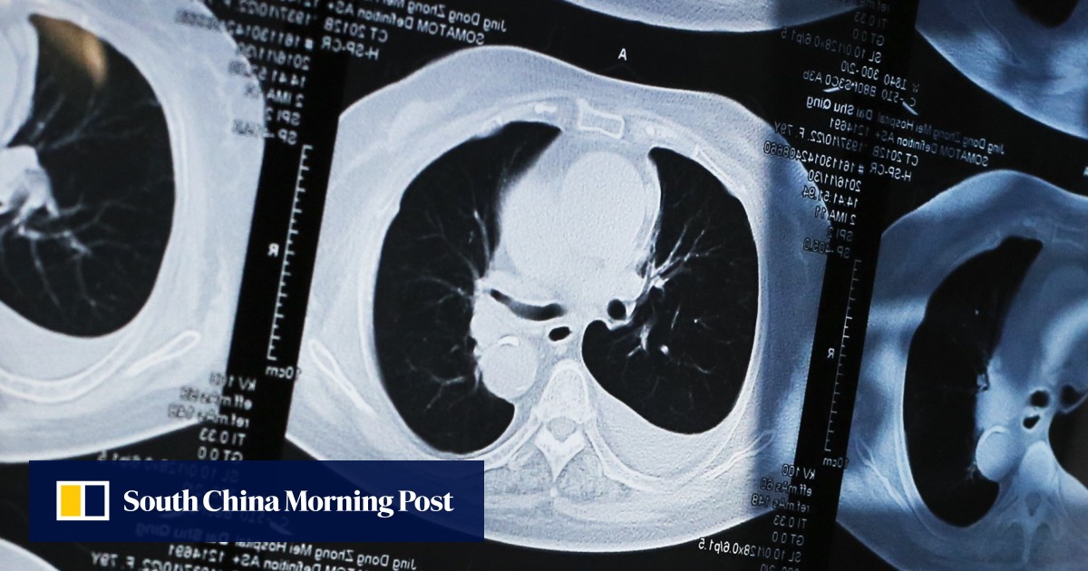 New lung cancer drug can prolong lives of latestage