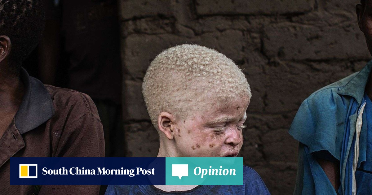 Albinos In Malawi Being Hunted For Their Body Parts For Witchcraft