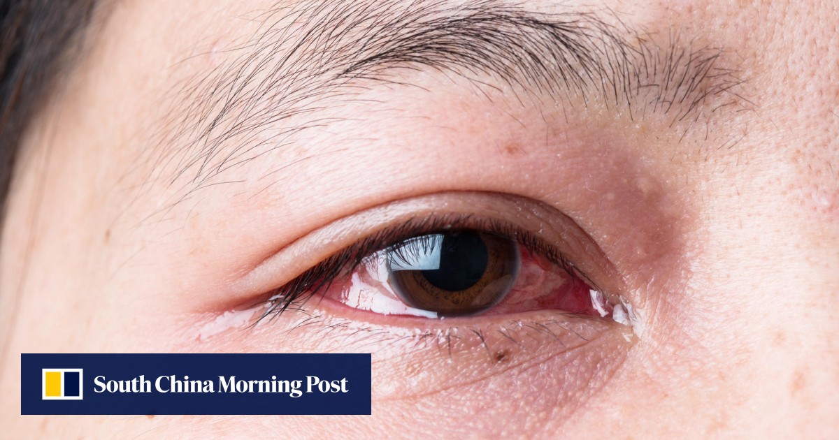 Inflammatory Eye Condition Iritis Should Be Treated Immediately